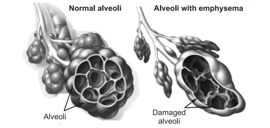 Difference between normal alveoli and alveoli with emphysema