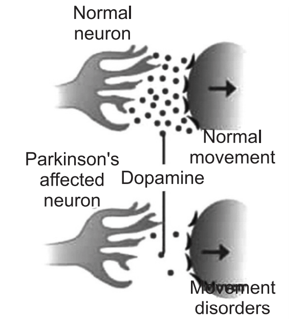 Dopamine levels in a normal and a Parkinson’s affected neuron