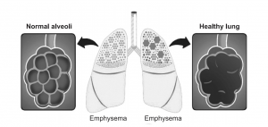 Emphysema – Causes, Risk Factors, Symptoms, Treatment