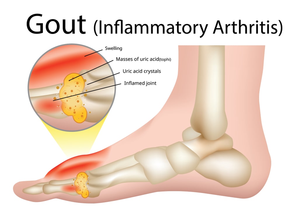 Gout - Causes, Symptoms, and Treatment - Solution Parmacy