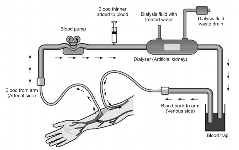 Chronic Kidney Disease – Causes, Symptoms, Treatments