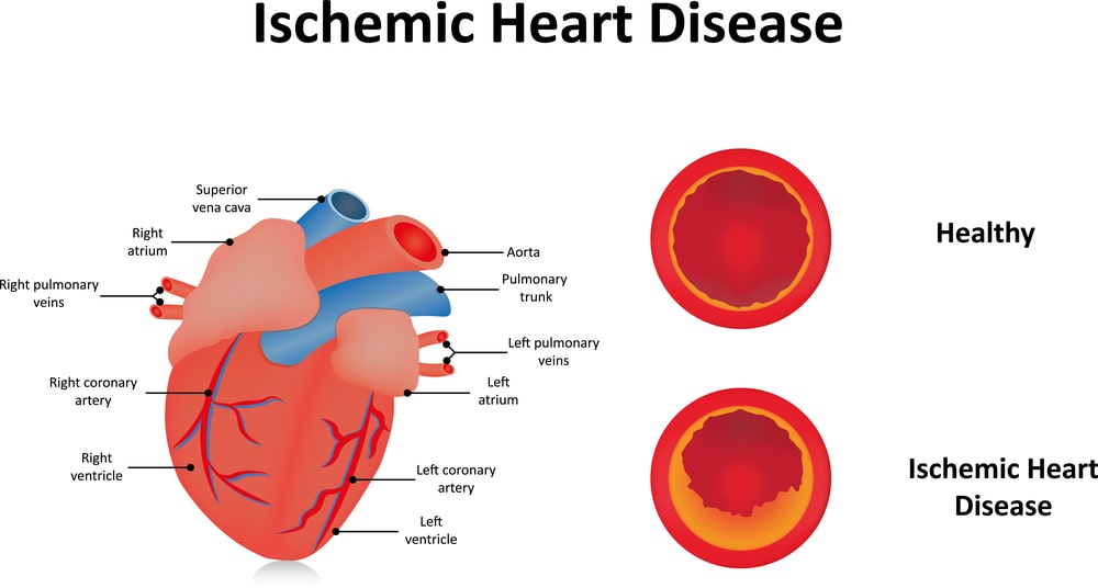 Ischaemic Heart Disease Pathogenesis Treatment 3754