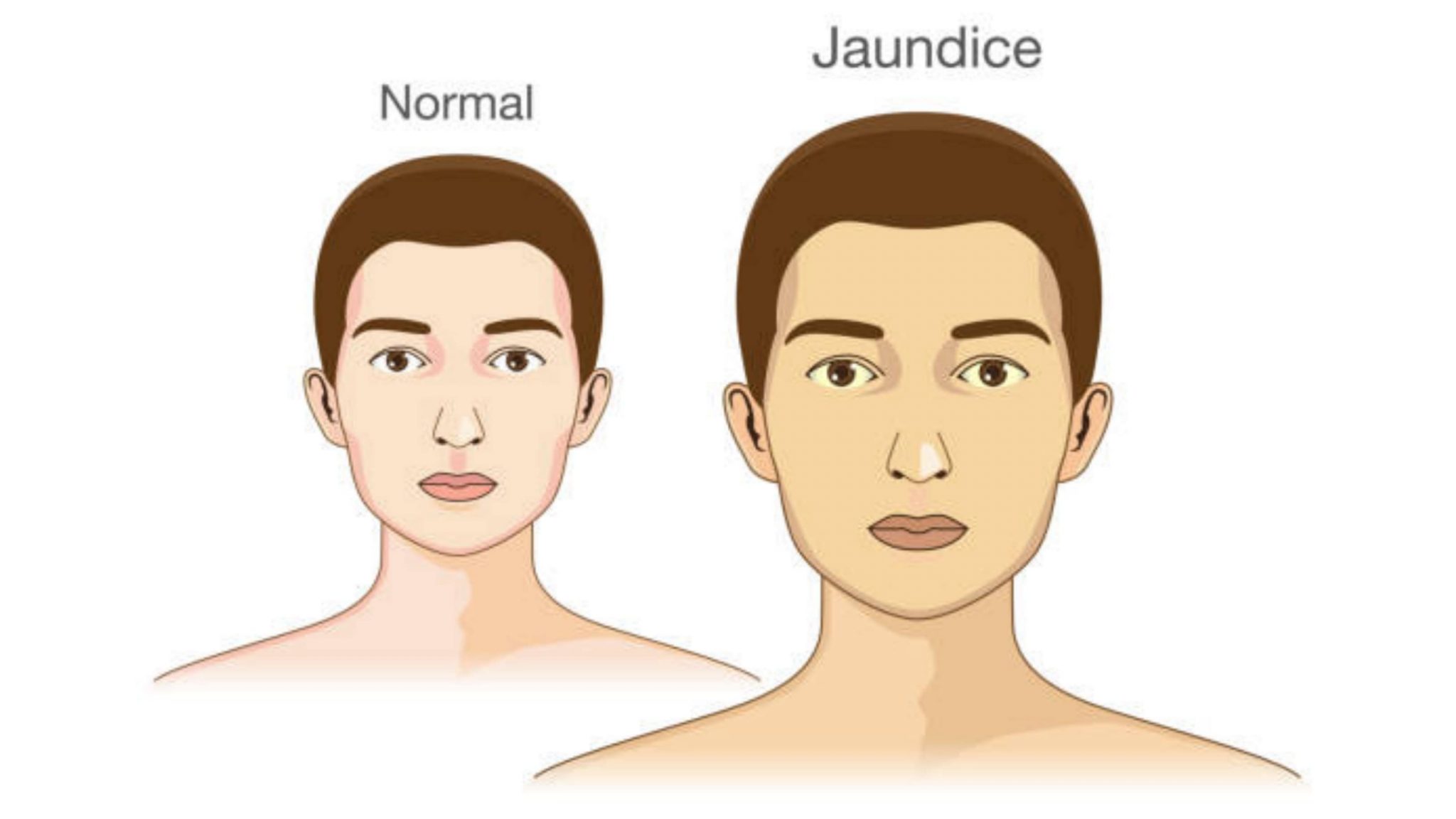 Jaundice Causes, Types, Symptoms, and Treatment Solution Parmacy