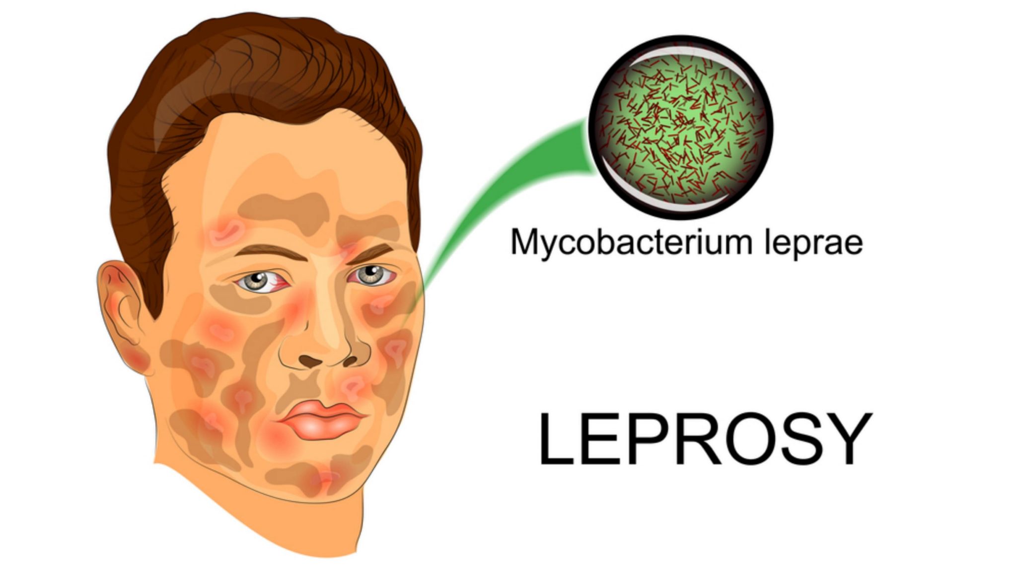 Leprosy Symptoms, Treatment and More Solution Parmacy