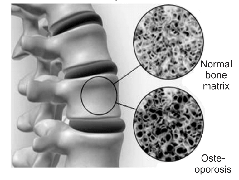 Normal and Osteoporosis bone