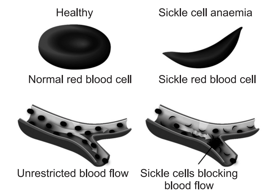 Normal and Sickle shape RBCs