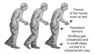 Parkinson’s Disease - Causes, Symptoms, Treatment, and Drugs