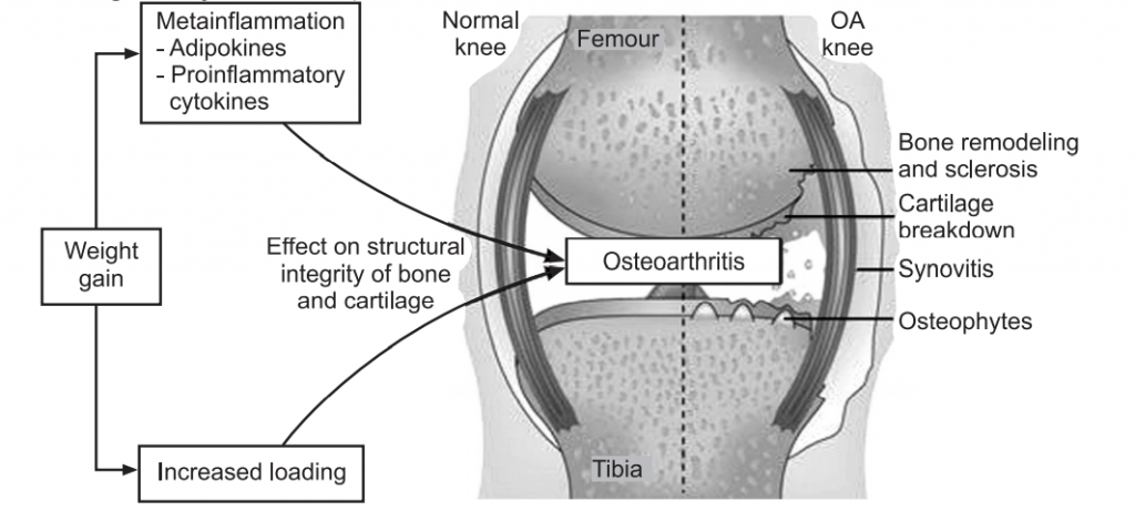 Pathogenesis of Osteoarthritis (OA)