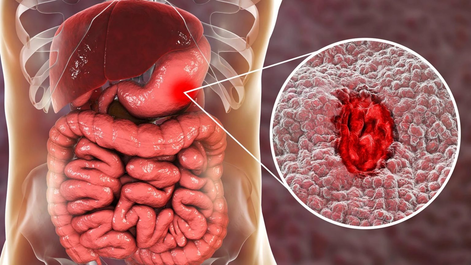 peptic-ulcers-pathophysiology-treatment-solution-parmacy