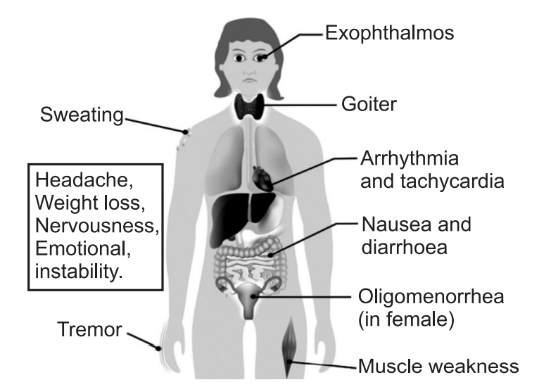 Symptoms of Grave’s disease