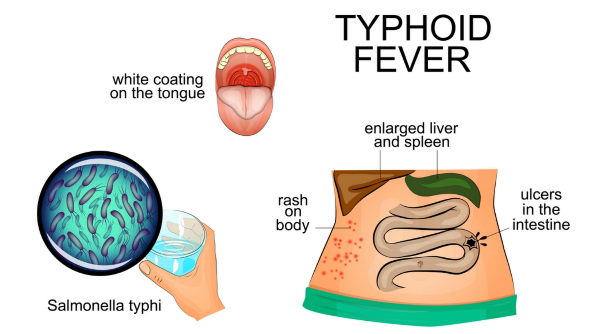 Typhoid Fever Symptoms Treatment And More Solution Parmacy