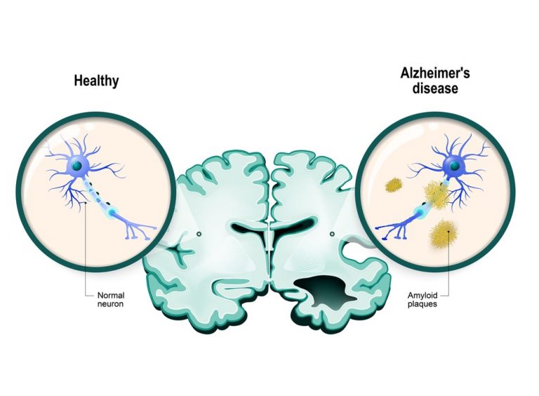 Alzheimer’s disease (AD) - Causes, Symptoms, and Treatment