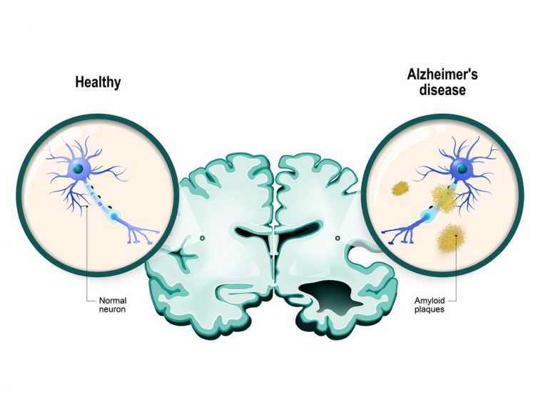 Alzheimer’s Disease (AD) - Causes, Symptoms, And Treatment