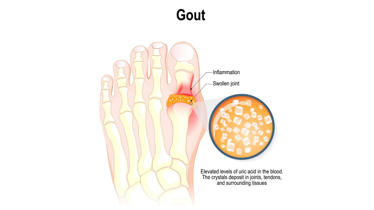 Anti-gout Drugs - Solution Parmacy