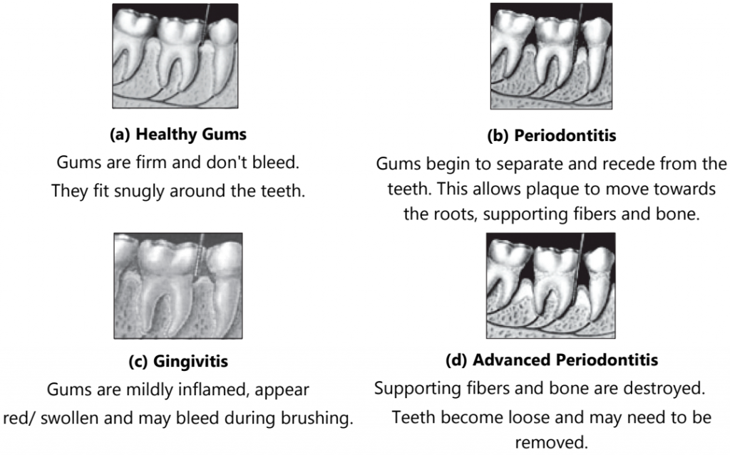 Stages of Gum disease 