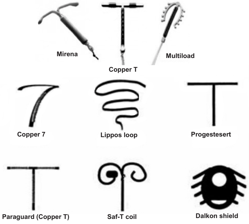 Types of Intrauterine Devices