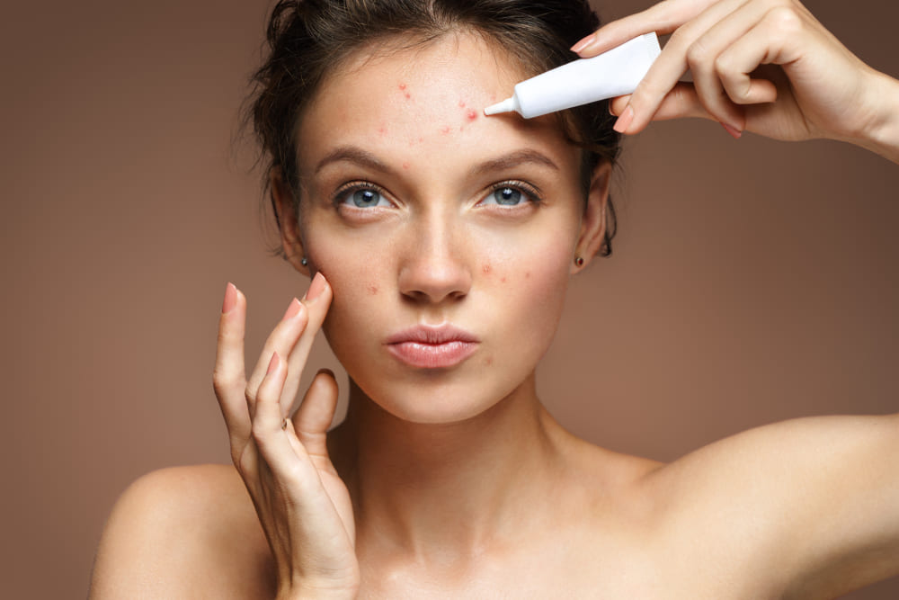 How to Make Polyherbal Anti-Acne Cream