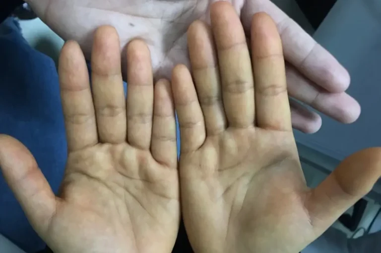 Can swelling in feet happen due to cancer?