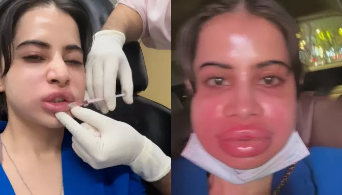 Uorfi Javed Looks Unrecognisable After Dissolving Lip Fillers, Says 'Buri Haalat Ho Gayi'